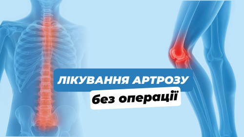 Лікування артрозу без операції Блог - Фото 20